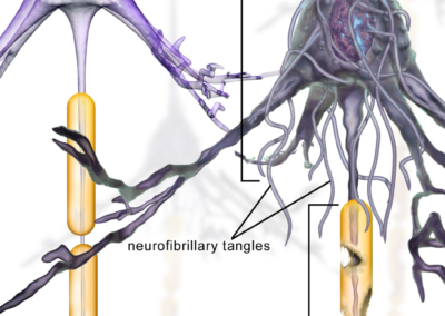 Alzheimer’s disease